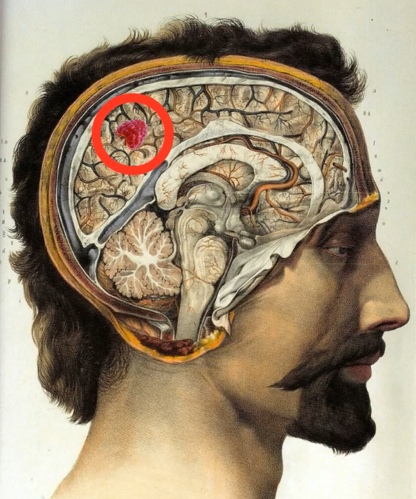 Recognizing and Treating the Common Hispanic Mutation (CCM1)